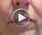 Filling and correction of the skin flaccidity around the mouth and between the nostrils and mouth