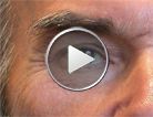 Gain de galbe du contour de l'œil par légère ascension du sourcil due au Botox®