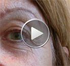 Raising of the outer portion of the upper eyelid and brow, allowing to clear the crow's feet wrinkles with Botox®