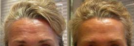 Annual correction of forehead wrinkles. Eyebrow lift