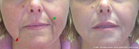 Rejuvenation of the peribuccal structures.<BR>Keeping two natural dimples