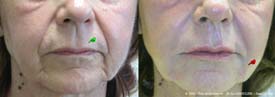 Skin sagging in the lower part of the face requiring reinflation of all structures.<BR>A facelift for the oval of the face would ideally complement these injections