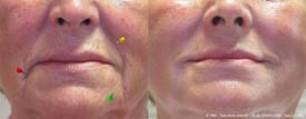 On good skin, an almost complete obliteration of nasolabial folds and bitterness Wrinkles