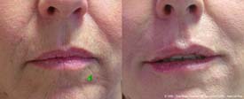 Filling and correction of the skin flaccidity around the mouth and between the nostrils and mouth