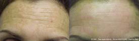 Attenuation of forehead wrinkles and spots 8 days after a TCA peel