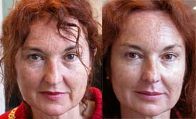 Eye contour lift with Botox® and reduction of facial wrinkles with hyaluronic acid and mesolift