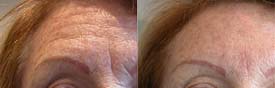 Treatment of forehead wrinkles with Botox® + hyaluronic acid