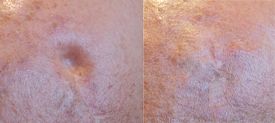 Filling scar with calcium hydroxyapatite gel Radiesse®