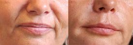 Cheekbone lift allowing to 'unwrinkl' nasolabial folds. Filling to reduce bitterness wrinkles.