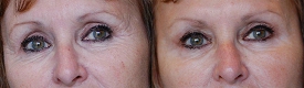 Treatment for the wrinkles of crow's feet, with only botox, and beautify the look with a lift up of the eyebrow