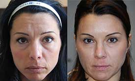 Treatment of expression wrinkles with a single injection of Botox . Lifting appearance on the eyelids and eyebrows, with 