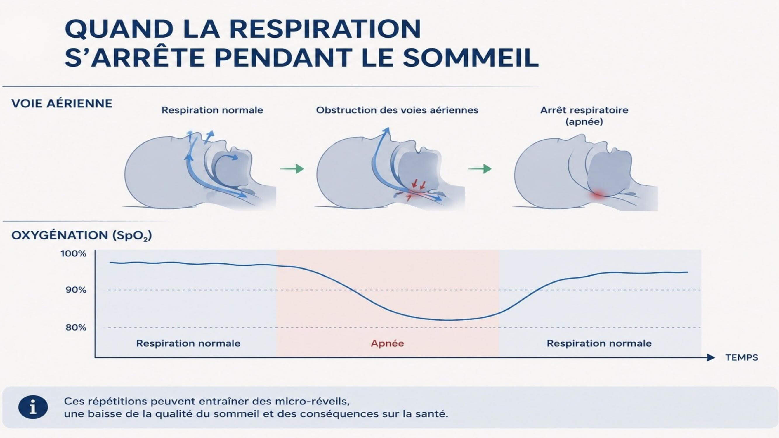 Physiopathologie de l'apnée du sommeil
